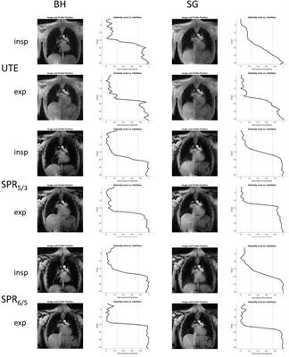Single-petal rosette trajectory for 2D functional lung imaging